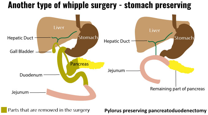 The Whipple Procedure Surgery Whipple Procedure Effects Success The Whipple Procedure Surgery Whipple Procedure Effects Success